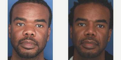 Man treated with Rhinoplasty, African American Rhinoplasty - Man treated with Rhinoplasty, African American Rhinoplasty