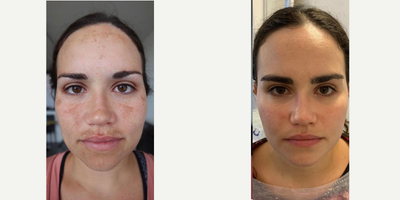 18-24 year old woman treated with Obagi Nu-Derm - Before and two months after hyperpigmentation treatment