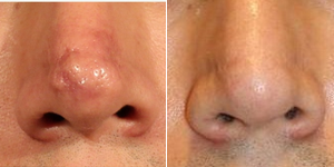 Laser Scar Removal with a series of Fraxel repair and Fraxel restore treatments - Dramatic improvement of nasal scarring with laser scar surfacing with a series of Fraxel repair and Fraxel restore treatments.