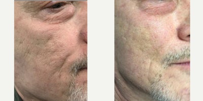 65-74 year old man treated with Bellafill, PRF Treatment, PRP Injections, Skin Rejuvenation - Improving the appearance of Acne Scarring with he combination of Dr. Song's signature Autocorre PRP Gel and Bellafill.
