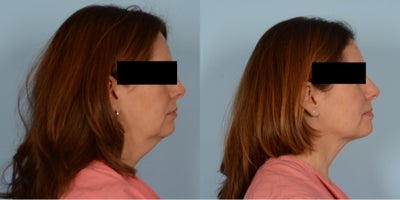 45-54 year old woman treated with Renuvion - Renuvion Neck