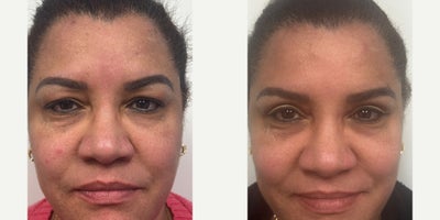 45-54 year old woman treated with Eyelid Surgery - 1 month after an upper eyelid blepharoplasty