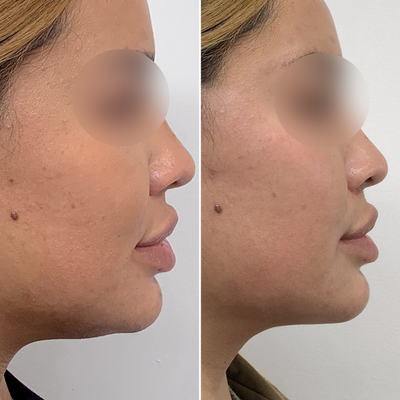 35-44 year old woman treated with CoolSculpting Elite - Patient wanted to diminish the appearance of the fat under her chin.