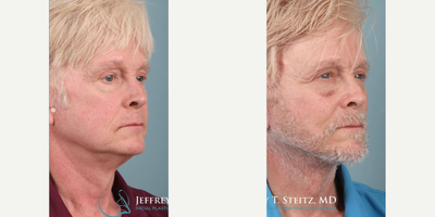 Man treated with Facelift Revision - Man treated with Facelift Revision
