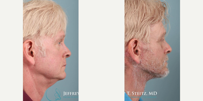 Man treated with Facelift Revision - Man treated with Facelift Revision