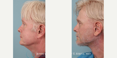 Man treated with Facelift Revision - Man treated with Facelift Revision