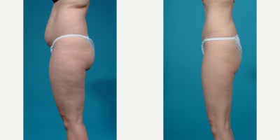 25-34 year old woman treated with Abdominal Etching, Diastasis Recti Repair, Drainless Tummy Tuck, Liposculpture, Liposuction, M - Standard tummy tuck with VASER ultrasound liposuction 360 and corset muscle plication.