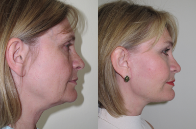 45-54 year old woman treated with SMAS Facelift - a 6 month result in a patient who underwent a SMAS facelift