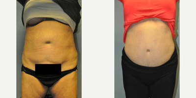 SculpSure - Sculpsure treatment causes a progressive loss of fat, and as these pictures show, the loss is ongoing and is more apparent as time goes by. At 6 months the improvement is remarkable.