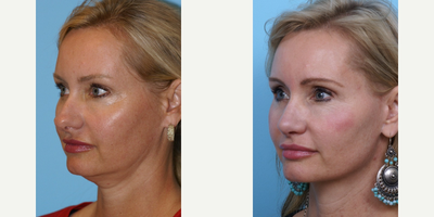 45-54 year old woman treated with Facelift - Facelift and Rhinoplasty