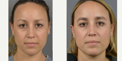 25-34 year old woman treated with Eyebrow Transplant - Patient presented with complaints of eyebrow hair loss and thinning due to over plucking, over waxing. At close to 6 months post-op, patient is pleased with results.  Physical Exam shows good brow contours with hair grown in nicely.