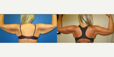 35-44 year old woman treated with Arm Lift - She lost weight and wanted the loose skin on her arms removed. Postoperative photos were taken 1 year after surgery.