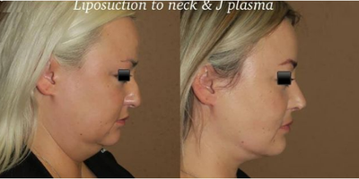 Woman treated with Liposuction - Combination surgery of rhinoplasty and liposuction of the neck with skin tightening J plasma