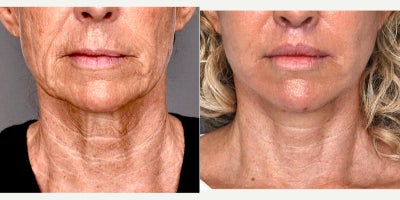 55-64 year old woman treated with Dermabrasion, TCA Peel, Lip Lift, Deep Plane Facelift, Neck Lift, Facial Fat Transfer - Deep plane facelift with extended neck dissection, upper lip lift, 35% TCA peeling, perioral dermabrasion, fat injection