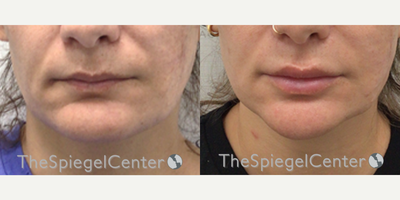 35-44 year old woman treated with Mandible Contouring - Mandible Contouring