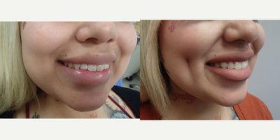 18-24 year old woman treated with Dimple Surgery - This patient underwent our customized Timeless Dimple (dimpleplasty) to enhance and complement their individual facial expression and features.