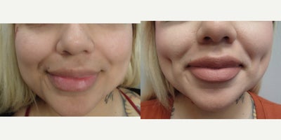 18-24 year old woman treated with Dimple Surgery - This patient underwent our customized Timeless Dimple (dimpleplasty) to enhance and complement their individual facial expression and features.