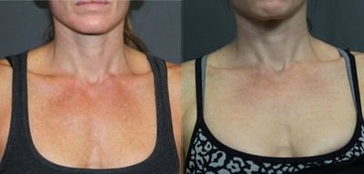 IPL to the Chest - Patient had two treatments of IPL to the chest to addresses uneven pigmentation, redness, sun damage, and surface imperfections.