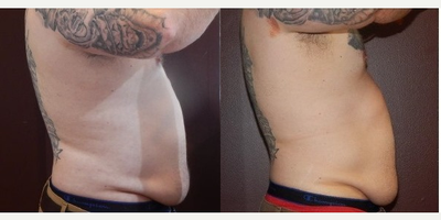 UltraSlim - Man treated with UltraSlim