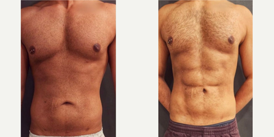 25-34 year old man treated with Liposculpture - Our patient, a young male model was struggling to achieve the abs he desired, despite dedicating countless hours to his workout regimen. That's when he came to us for help.We did #360liposuction for him with bodytite to tighten the skin and voila! we were able to give him the #naturallooking results he has been yearning for a long time.Bodytite is a revolutionary technology that utilizes radiofrequency energy to tighten skin and improve contouring. By combining this with a 360 liposuction using MicroAire and VaserPureliposuction we were able to sculpt the patient's midsection and give him the definition he was looking for. The belly button was also finely stretched with the impact of bodytite, for amazing results #theRGEffectCosmetic surgery should always look and feel natural. The success of #cosmeticsurgery lies in achieving a fine balance of getting what patients desire while keeping the results so natural that people cant make out if the results have been achieved via surgery or in a gym.We take pride in using the latest technology and techniques combined with aesthetic skillsand an eye to detailto deliver results that leave our patients feeling more confident and comfortable in their bodies.