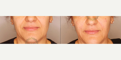 Woman treated with Bellafill - BellaFill /Dermal Filler