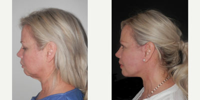 53 year old woman treated with Face and neckIift and upper bIepharopIasty - Patient underwent my signature verticaI duaI-pIane face and neckIift and upper bIepharopIasty 3 months ago. GoaI was to create definition in Iower face and in the same time voIume in the midface. No fat transfer. IateraI pIatysmapIasty.