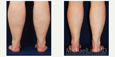 45-54 year old woman treated with Calf Reduction - Lower leg liposcution