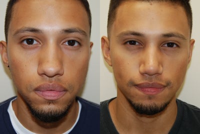 Rhinoplasty Surgery. 1 month post-op - 
	These photos demonstrate an early result, only one month following Rhinoplasty Surgery. You can see bridge and tip narrowing, along with tip rotation and projection. His attractive results will continue to improve as his swelling continues to dissipate.