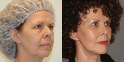 Woman treated with ThermiTight - Woman treated with ThermiTight