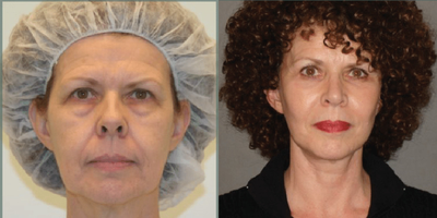 Woman treated with ThermiTight - Woman treated with ThermiTight