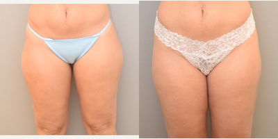 35-44 year old woman treated with SAFELipo - 40 yo s/p liposuction outer thigh performed under local anesthesia with sedation in our on site certified operating suite.