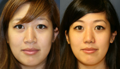 Rhinoplasty - 
	She wanted bump on top of nose lowered. Open rhinoplasty to lower dorsum, increase tip projection, refine tip, and narrow base of nose. Photos before and two months after. Swelling still resolving.
