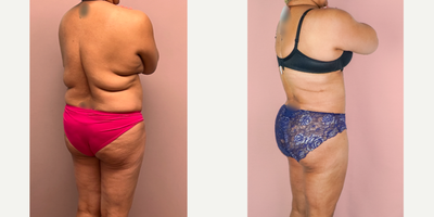 55-64 year old woman treated with Liposuction, Brazilian Butt Lift - This patient underwent a 360 Liposuction procedure with fat grafting to the buttocks/hips.