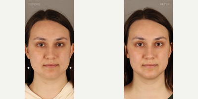 Non-Surgical Facial Slimming - Botox to Masseter Muscles - 27-year-old female who presented complaining that her face had become more square. We diagnosed the issue as masseter (chewing muscle) enlargement, which was confirmed when she reported pain and tooth damage from grinding and clenching her teeth. She is shown 4 weeks after neurotoxin (Botox) treatment to these muscles, resulting in jawline slimming and a more heart-shaped face. She also has complete relief from her symptoms related to teeth grinding and clenching.