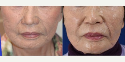 75 and up year old woman treated with Laser Resurfacing, Sculptra - It's never too late to look pretty.  This is our 91 year old patient that still wants to feel good about how she looks.  Recently she underwent laser resurfacing and Sculptra injections.  Feeling confident does not have an age limit.