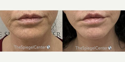 55-64 year old woman treated with Ellacor - 55-64 year old woman treated with Ellacor