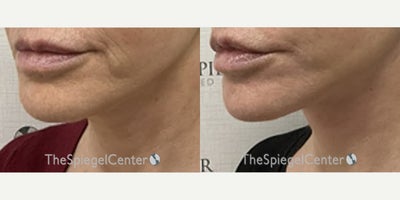 55-64 year old woman treated with Ellacor - 55-64 year old woman treated with Ellacor