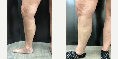 55-64 year old woman treated with Varithena - patient received varithena treatment as well as Sclerotherapy. These are her results at the one-month post-op examination.