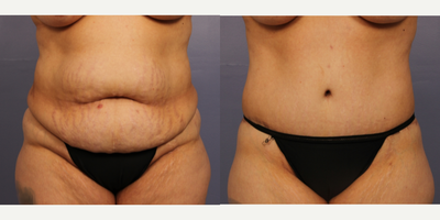 Drainless Tummy Tuck - Mid 30s female, underwent No-drain Tummy tuck and liposuction of her abdomen, love handles and lower back area.