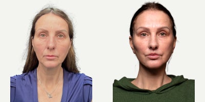 55-64 year old woman treated with Facelift, Neck Lift, Eyelid Surgery, Facial Fat Transfer, Lip Lift - Lesley is 57 years old and traveled from the UK with a clear goal: to look fresher and more rested  while still looking like herself.For the upper face, I performed an endoscopic forehead lift together with an upper blepharoplasty and a temporal lift to restore a softer brow position and create a more open, refreshed eye contour. A cantopexy was also added for additional eyelid support.For the lower eyelids, I performed a lower blepharoplasty to smooth the transition between the eyelid and cheek area.To improve overall facial harmony, I performed fat grafting to selected areas to restore natural volume and support softer contours.For the face and neck, the main structural correction included an extended deep plane facelift combined with a neck lift, helping redefine the jawline and create a more elegant neck profile.For the perioral area, a lip lift was performed to restore a more youthful lip shape and balance.This comprehensive approach allowed us to achieve a result that looks natural, balanced, and refreshed  while keeping Lesley unmistakably herself.