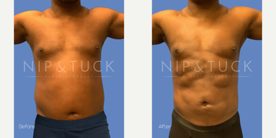 35-44 year old man treated with Liposuction - Vaser lipo 360 + chest, 3 months post-opWeight: 202 lbs Height: 5'10 BMI: 29