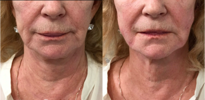 NovaThreads in the Jowls, Female, Late 60s - This is before and immediately after NovaThreads were placed in the jowl area as well as nasolabial folds.