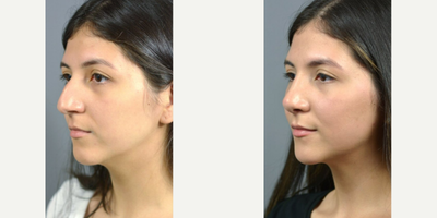 Rhinoplasty - Woman treated with Rhinoplasty