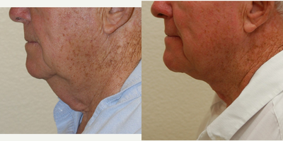 75 and up year old man treated with Neck Lift - This very pleasant gentleman was unhappy with his turkey neck. Dr. Richards performed a direct necklift to address this anterior neck skin laxity and laxity of the platysma muscle.