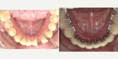 4 Month Progress Photo - This patient is being treated for lower spaces with InBrace - check out this 4 month progress photo!