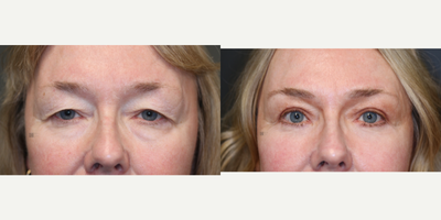 Enigmalift - upper and lower eyelid surgery with browlift fat transfer, laser.