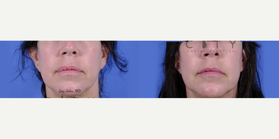 Woman treated with Lip Reduction - This wonderful patient had a V to Y upper lip advancement elsewhere and was left with redundant red lip tissue that was aesthetically and functionally problematic. We corrected the upper lip with a calculated lip reduction to restore lower face harmony. It all increased her upper tooth show.