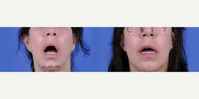 Woman treated with Lip Reduction - This wonderful patient had a V to Y upper lip advancement elsewhere and was left with redundant red lip tissue that was aesthetically and functionally problematic. We corrected the upper lip with a calculated lip reduction to restore lower face harmony. It all increased her upper tooth show.