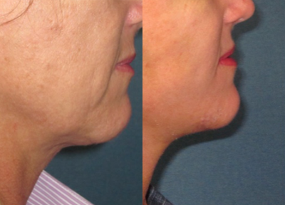 45-54 year old woman treated with Lower Face Lift - Natural appearing lower face/neck lift
