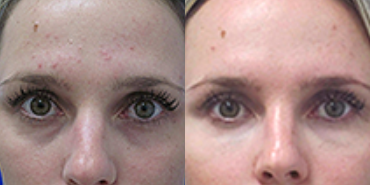 35-44 year old woman treated with Belotero - Tear through deformity; patient thought her undereyes made her look tired